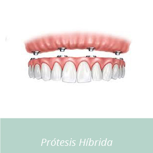 prótesis híbrida