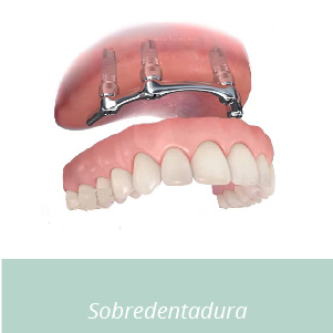 tipos de implantes dentales