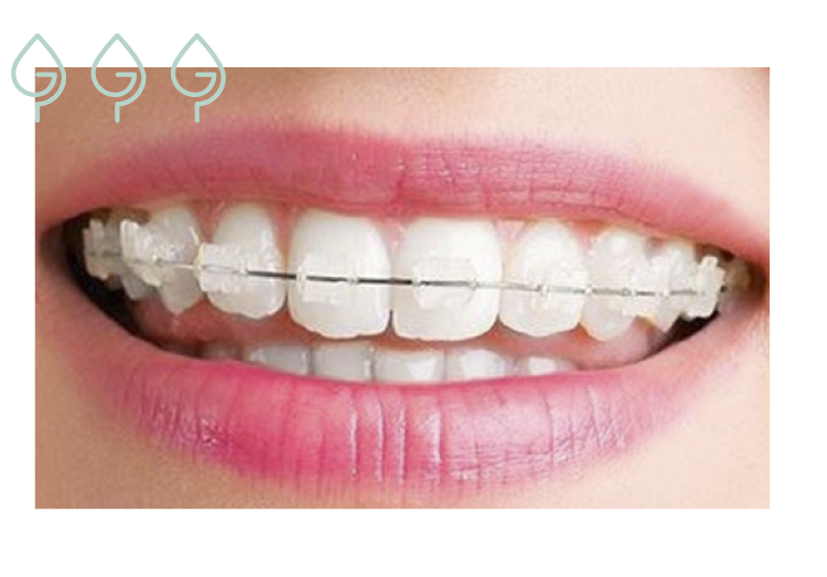 Brackets invisibles: ¿qué son y qué los diferencia de los normales?