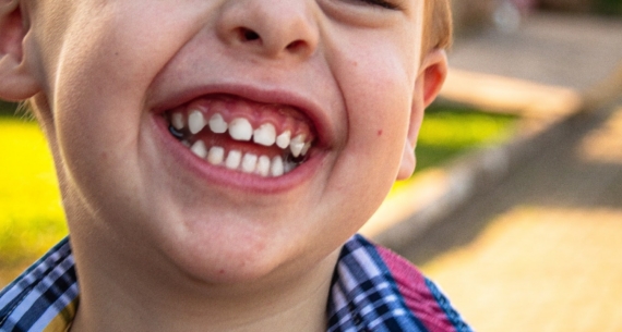 Maloclusión dental, ¿qué hacer si no mastico bien?