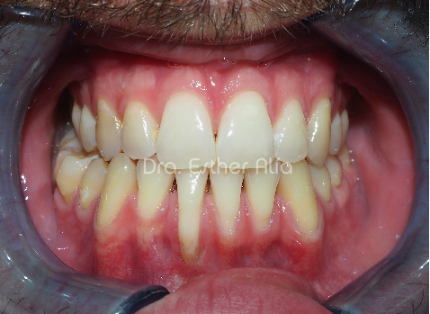 enfermedades periodontales