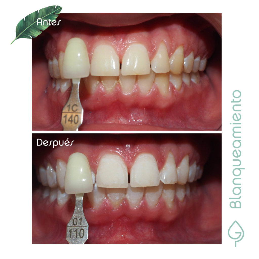 blanqueamiento dental