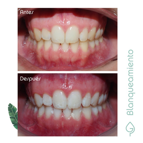 blanqueamiento dental