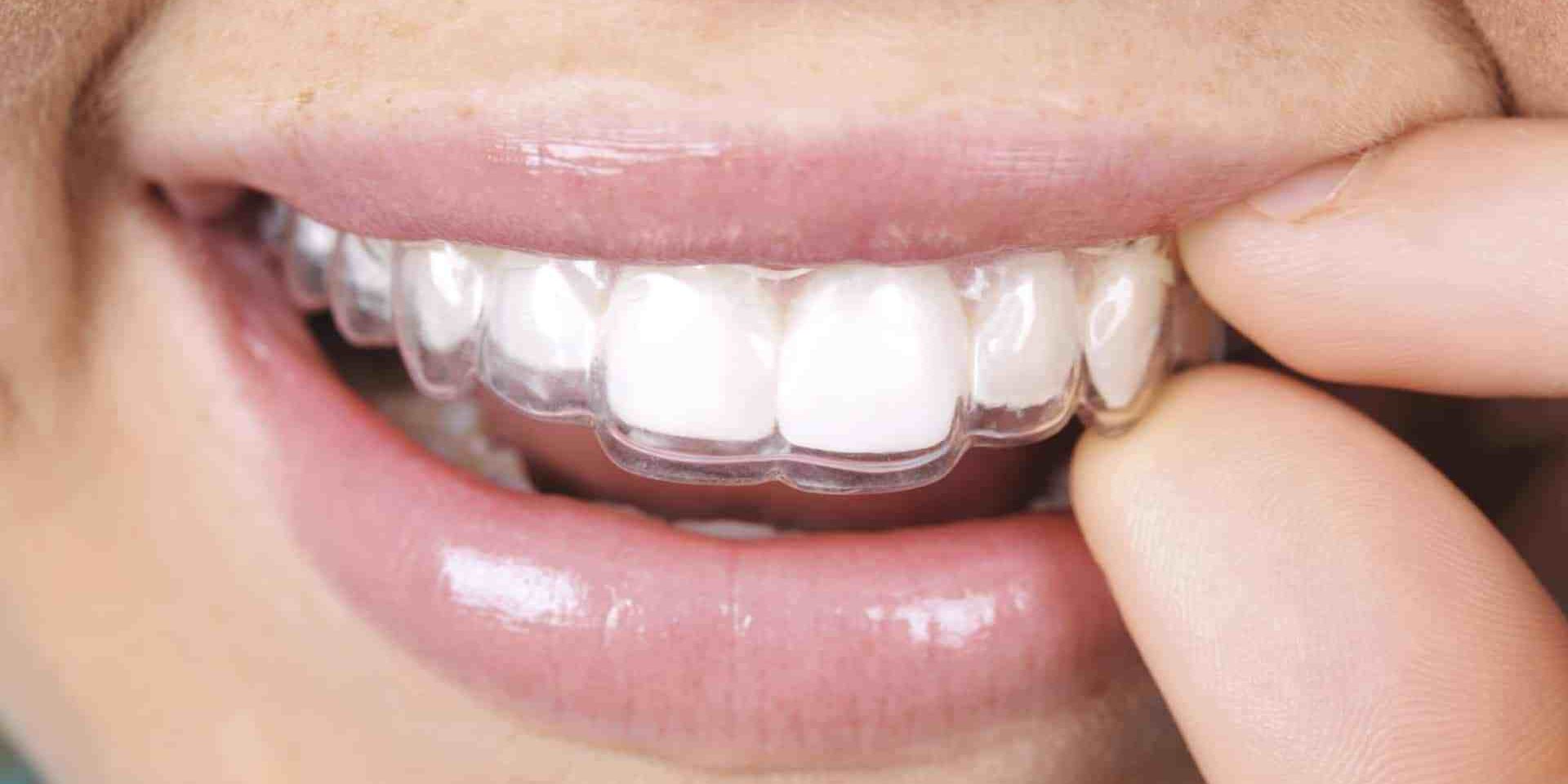 Contribución Cubo en Retenedores dentales, ¿qué son? - Clínica Garden