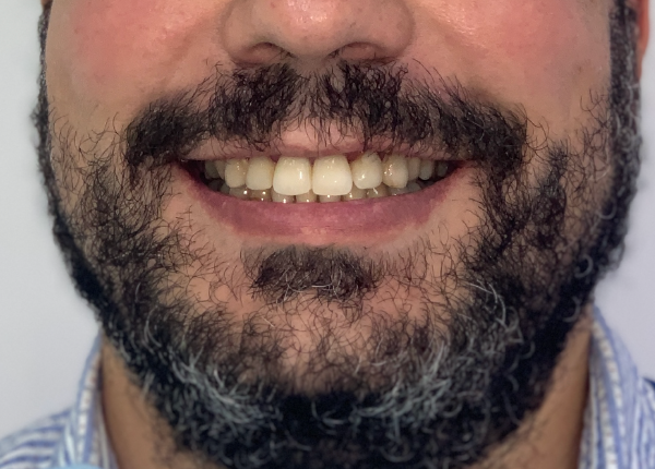 Pedro, protrusión labial. Invisalign