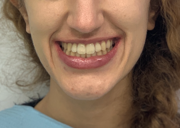 Irene. Mordida abierta. Invisalign