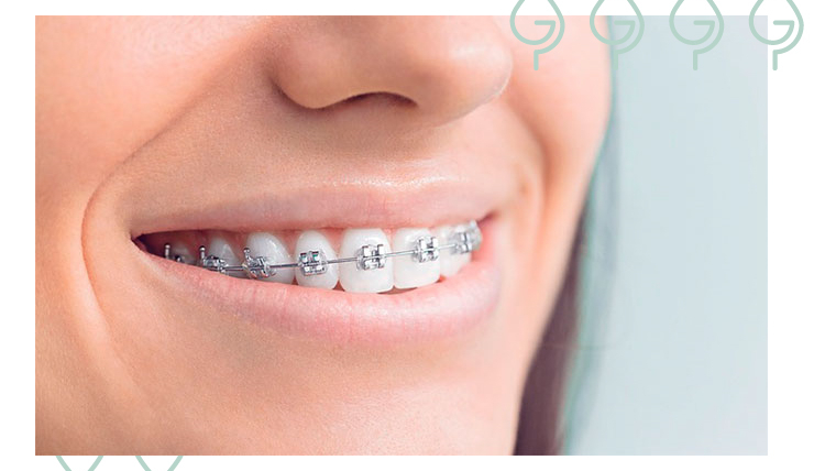 ¿Para qué sirven las gomas de los brackets?