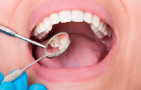¿Qué son las fisuras en los dientes? Soluciones.