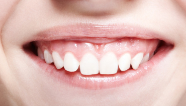 Las tres caras de la sonrisa gingival. Revisión bibliográfica.