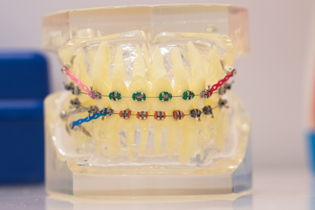 ¿Para qué sirven las gomas de los brackets?