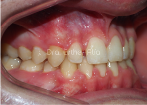 prognatismo mandibular