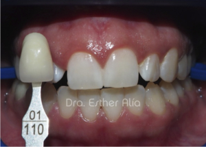 tratamiento dientes oscuros