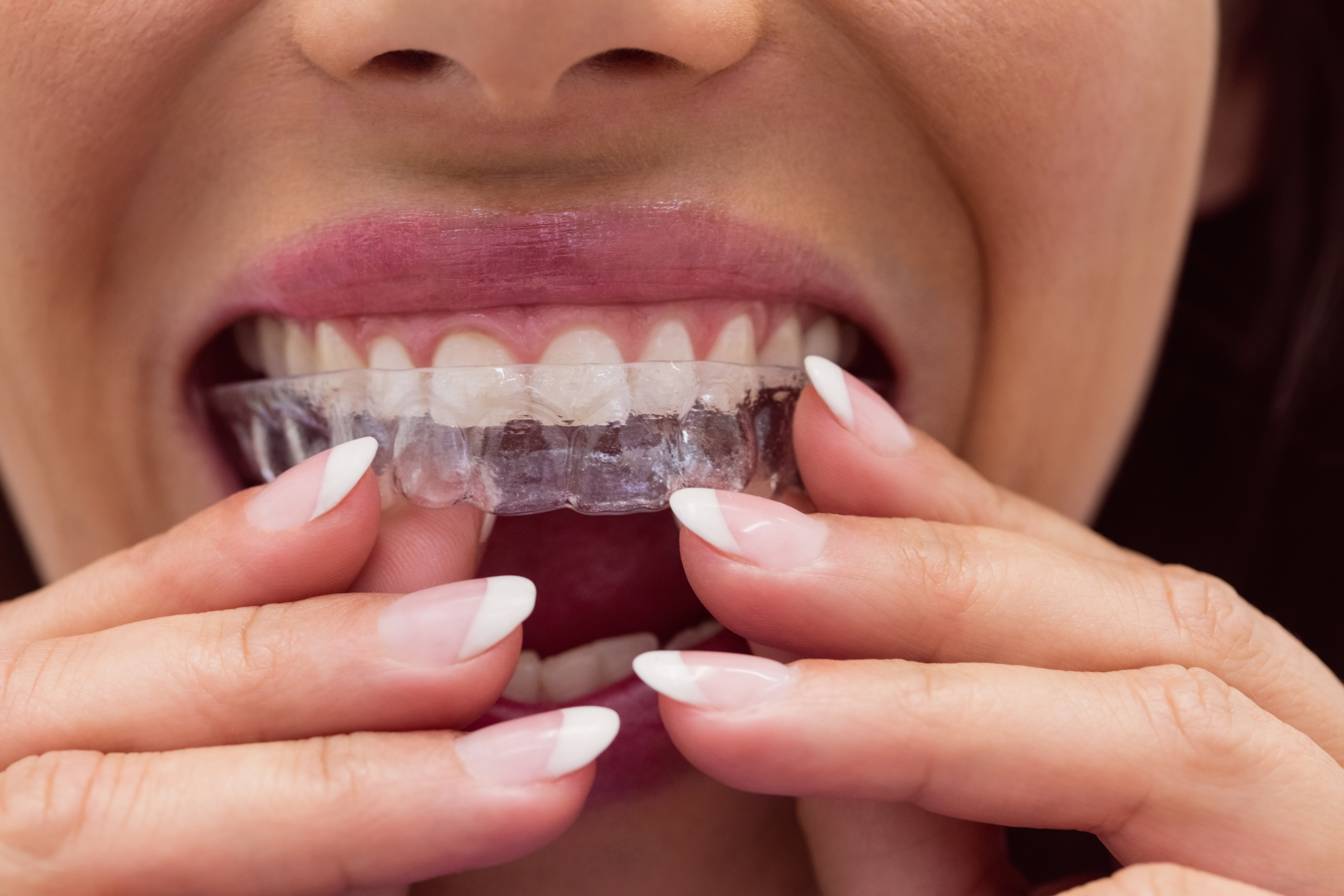 Mitos sobre la ortodoncia invisible