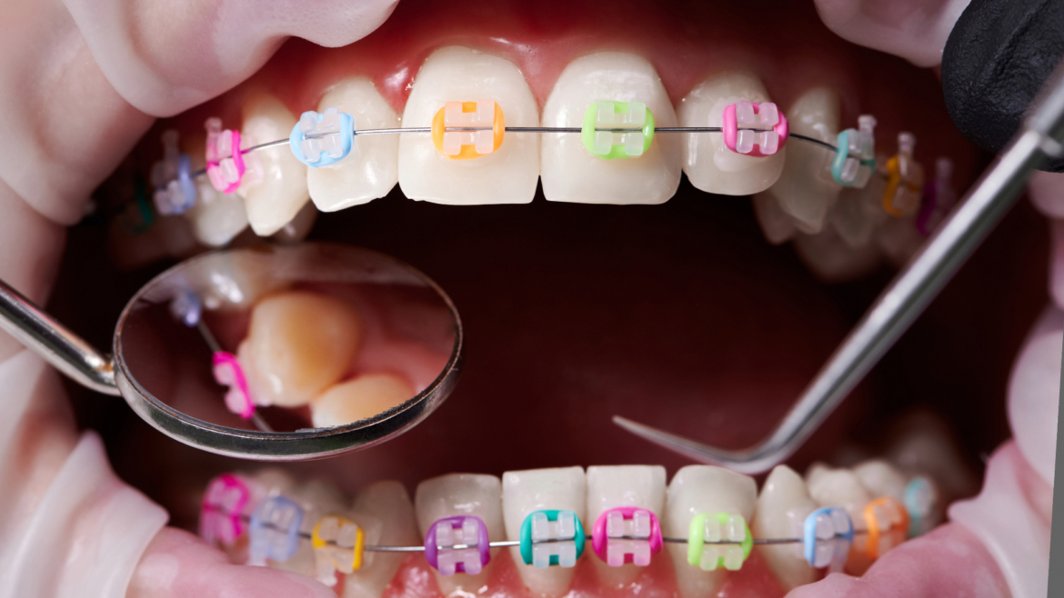 Opciones de ortodoncia, ¿cuál es la que más se adapta a ti?