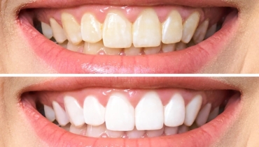 Fluorosis dental. Todo lo que necesitas saber.