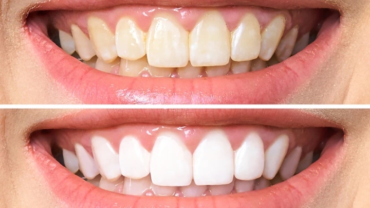 Fluorosis dental. Todo lo que necesitas saber.