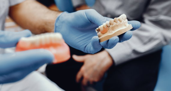 Prótesis dentales fijas: todo lo que debes saber